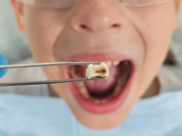 Best Emergency Tooth Extraction in Porcupine, SD